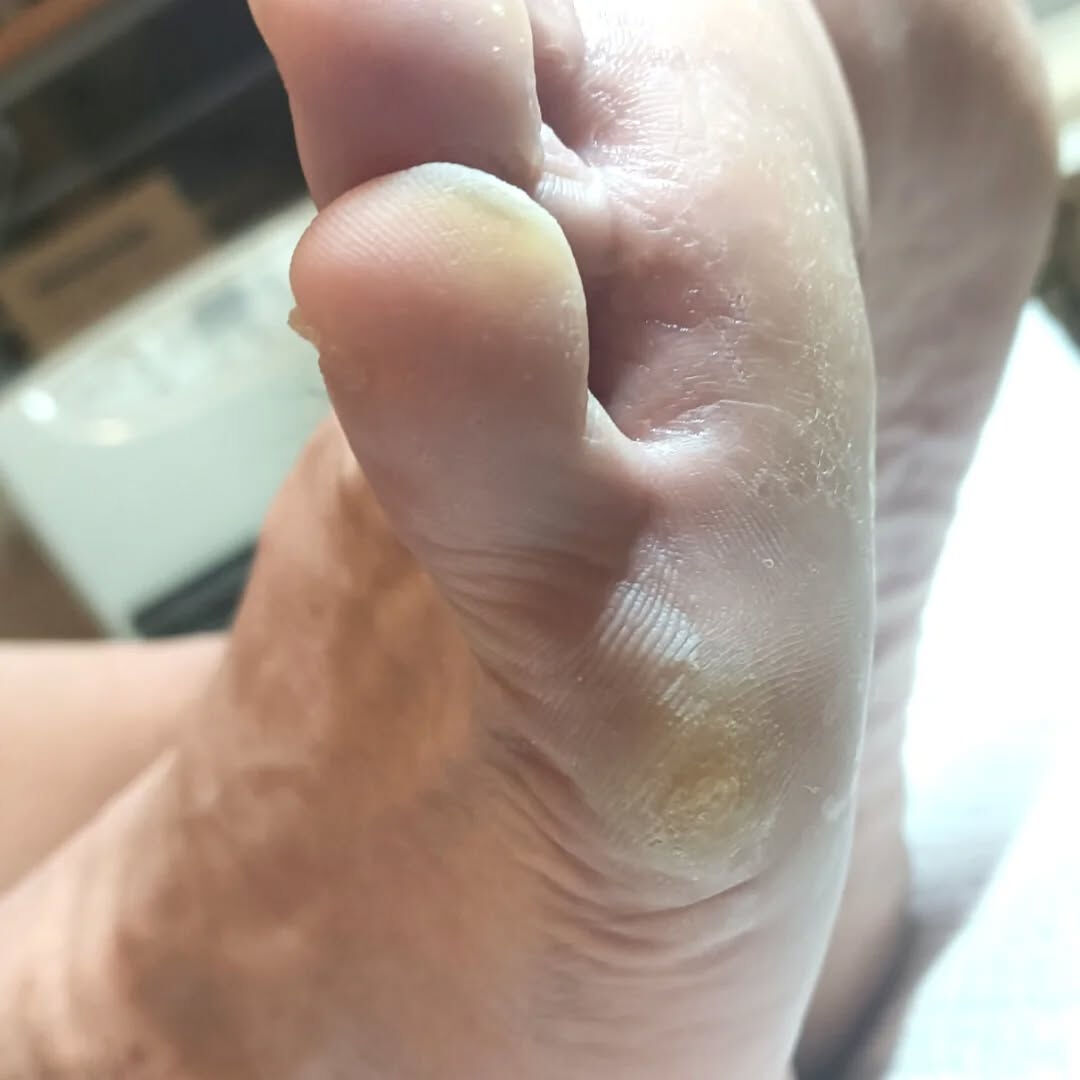 魚の目ケア👣✨
