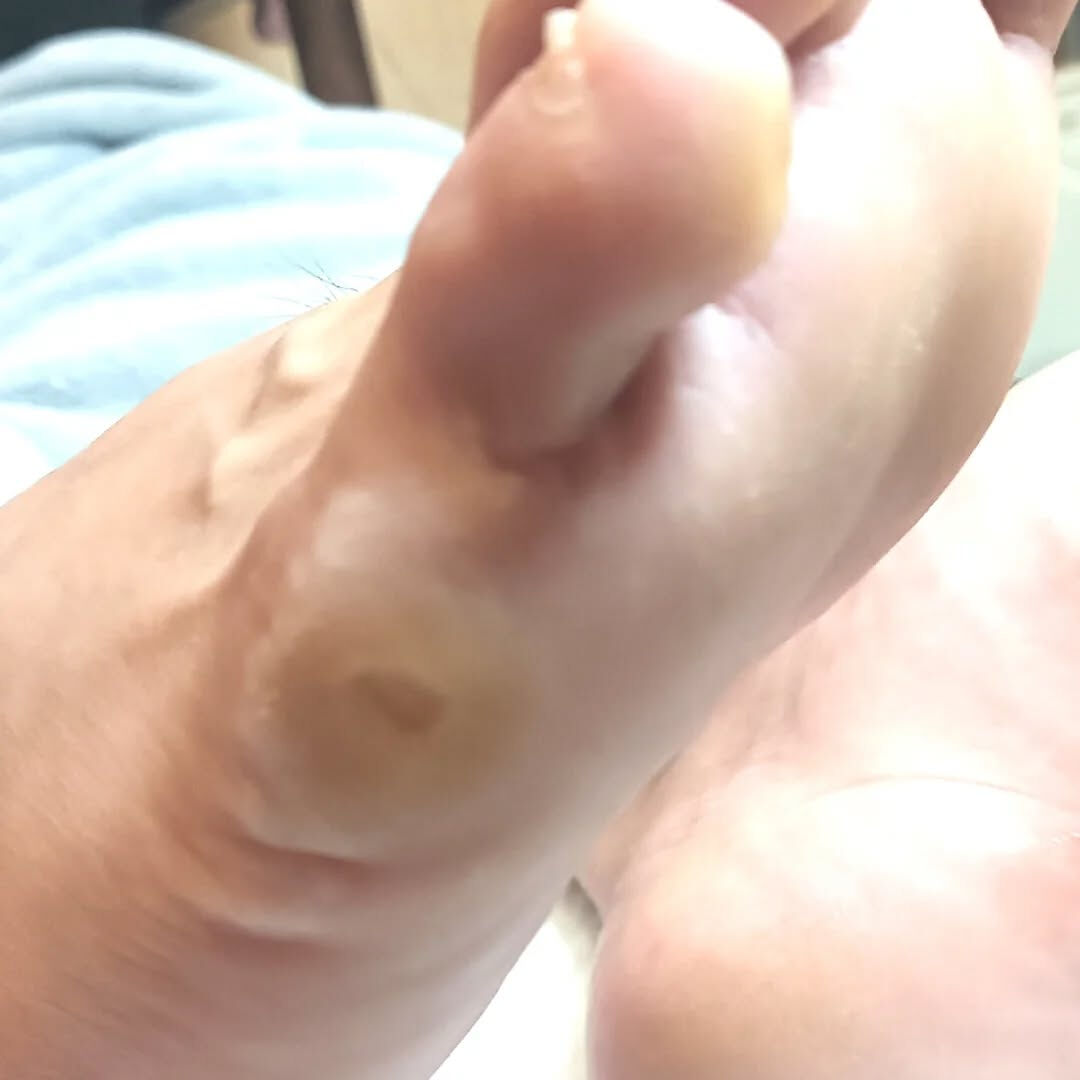 魚の目ケア👣✨