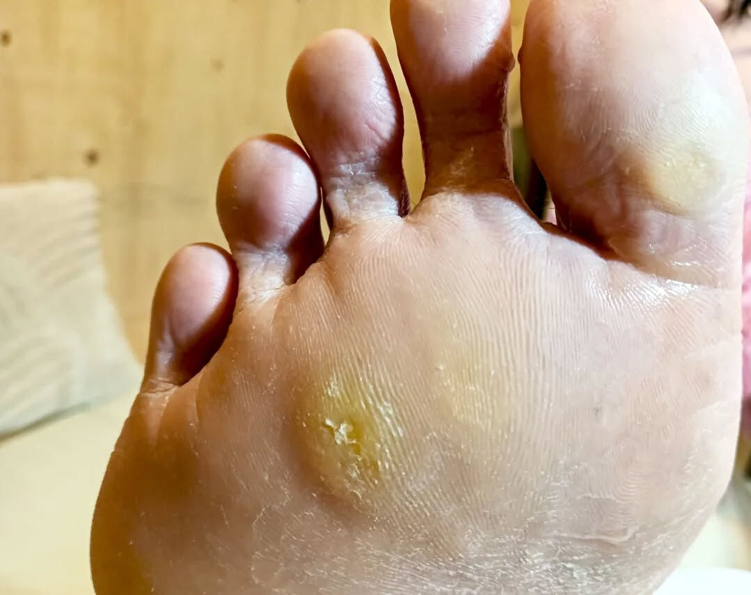 タコ、魚の目ケア👣✨
