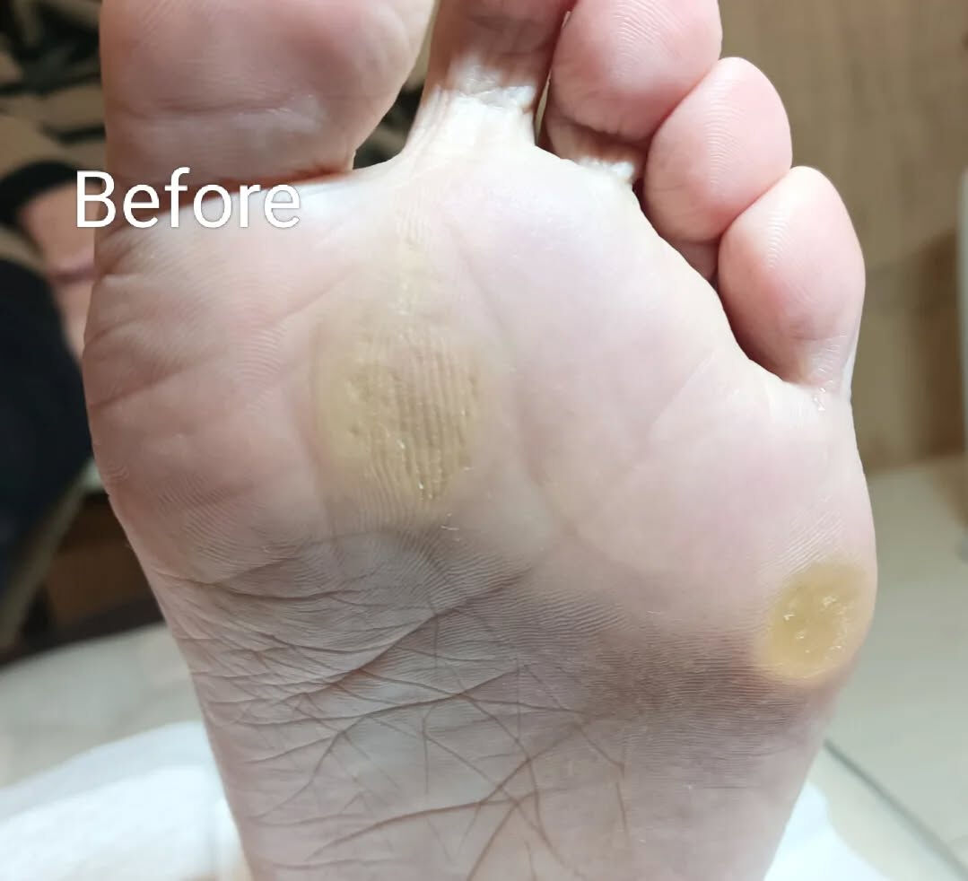 タコ＆魚の目ケア👣✨