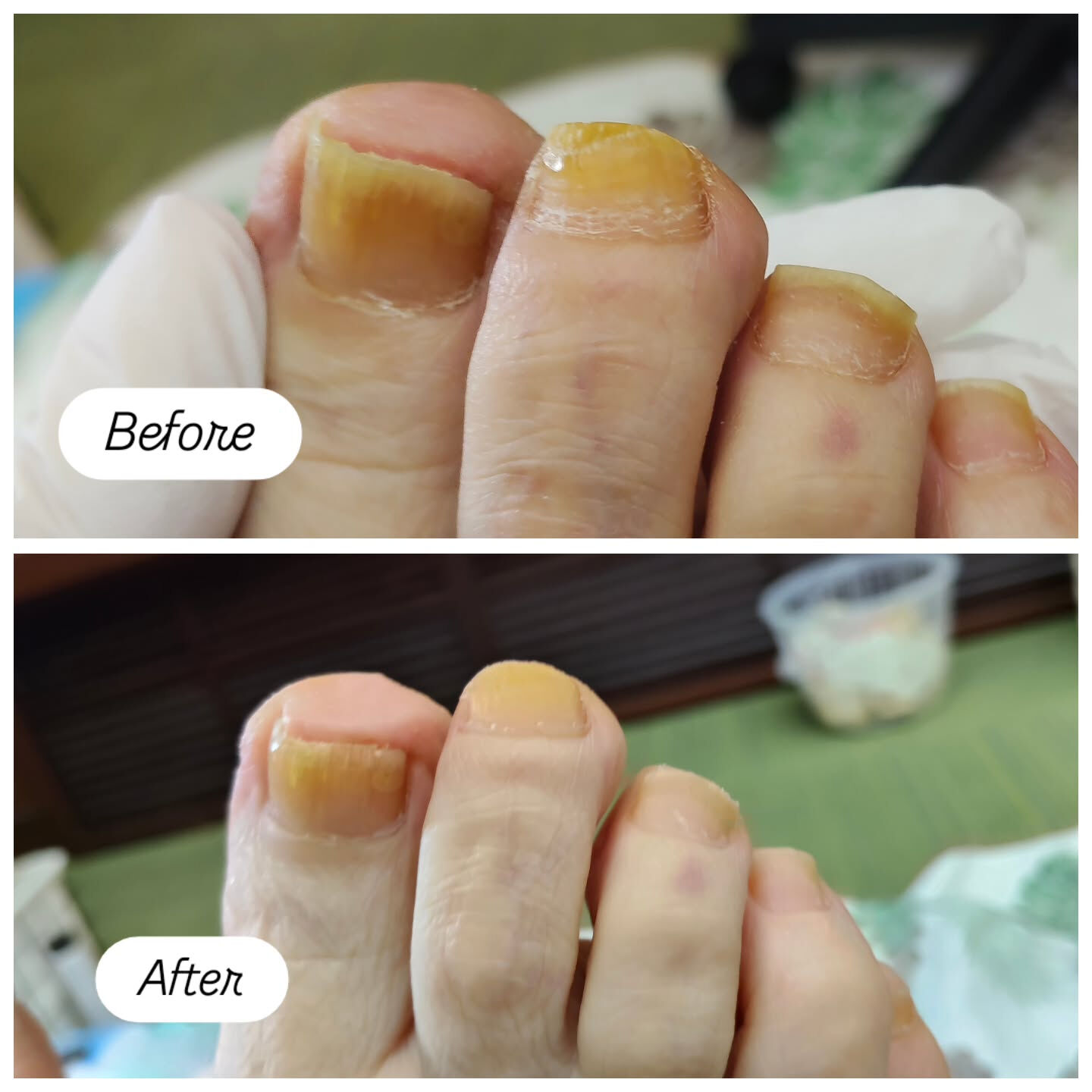 肥厚爪ケア👣✨