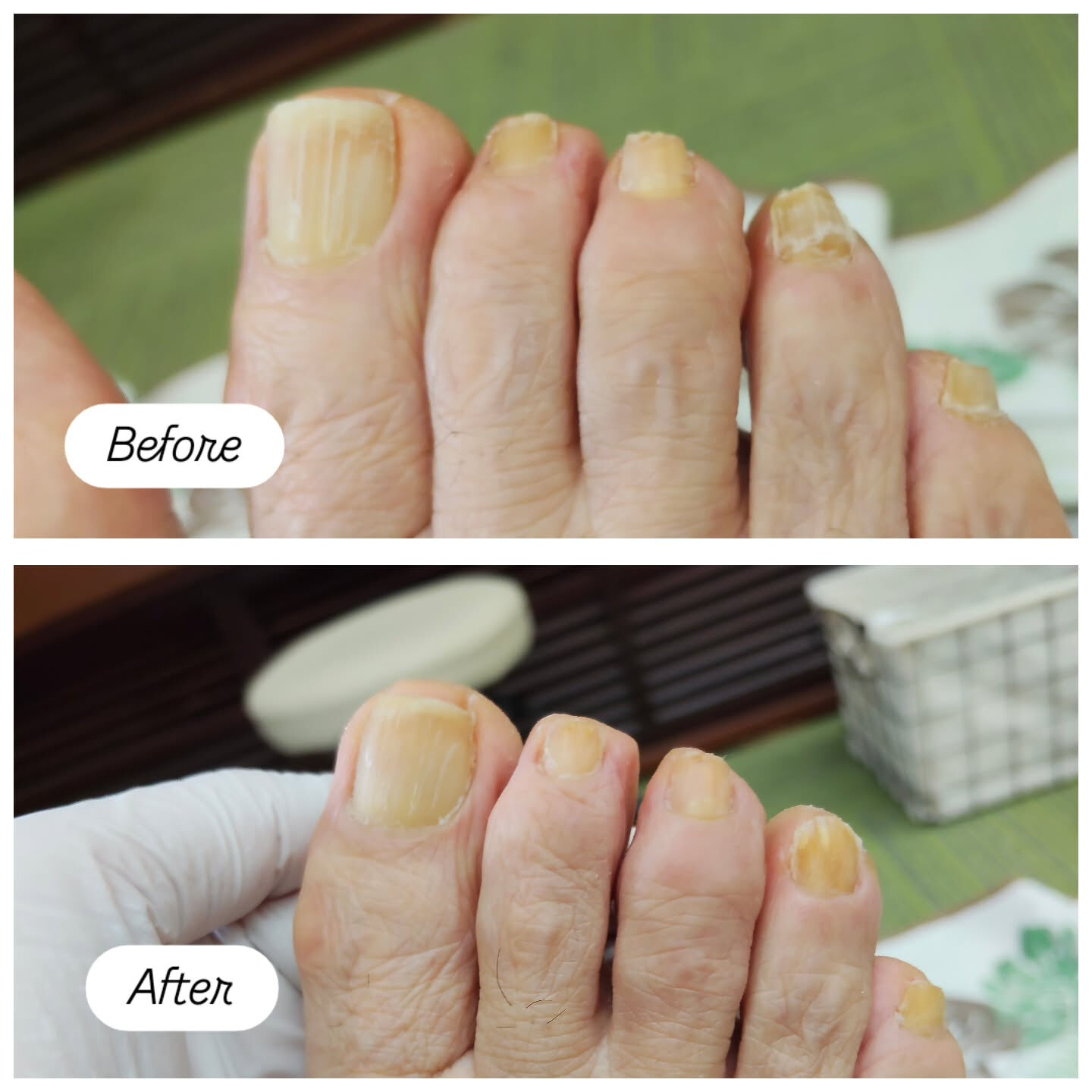 肥厚爪ケア👣✨