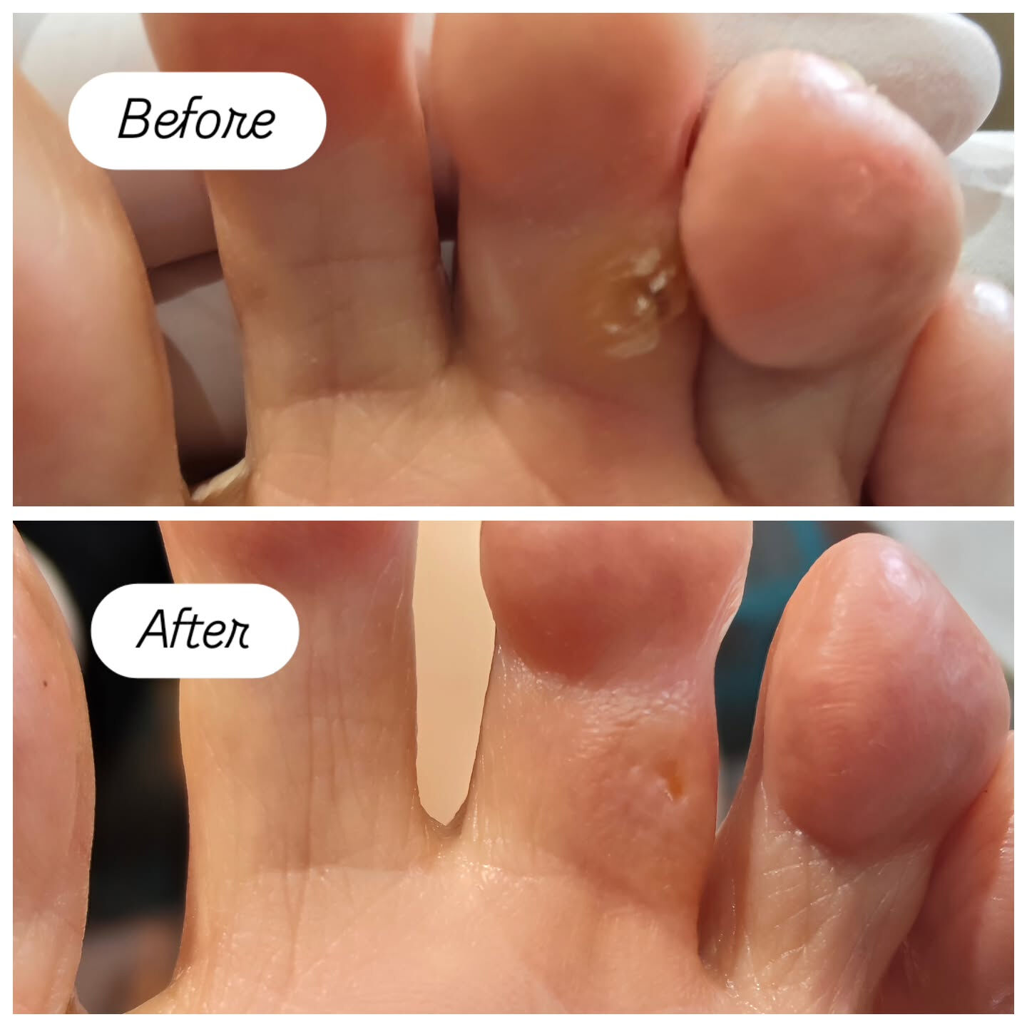 魚の目ケア👣✨
