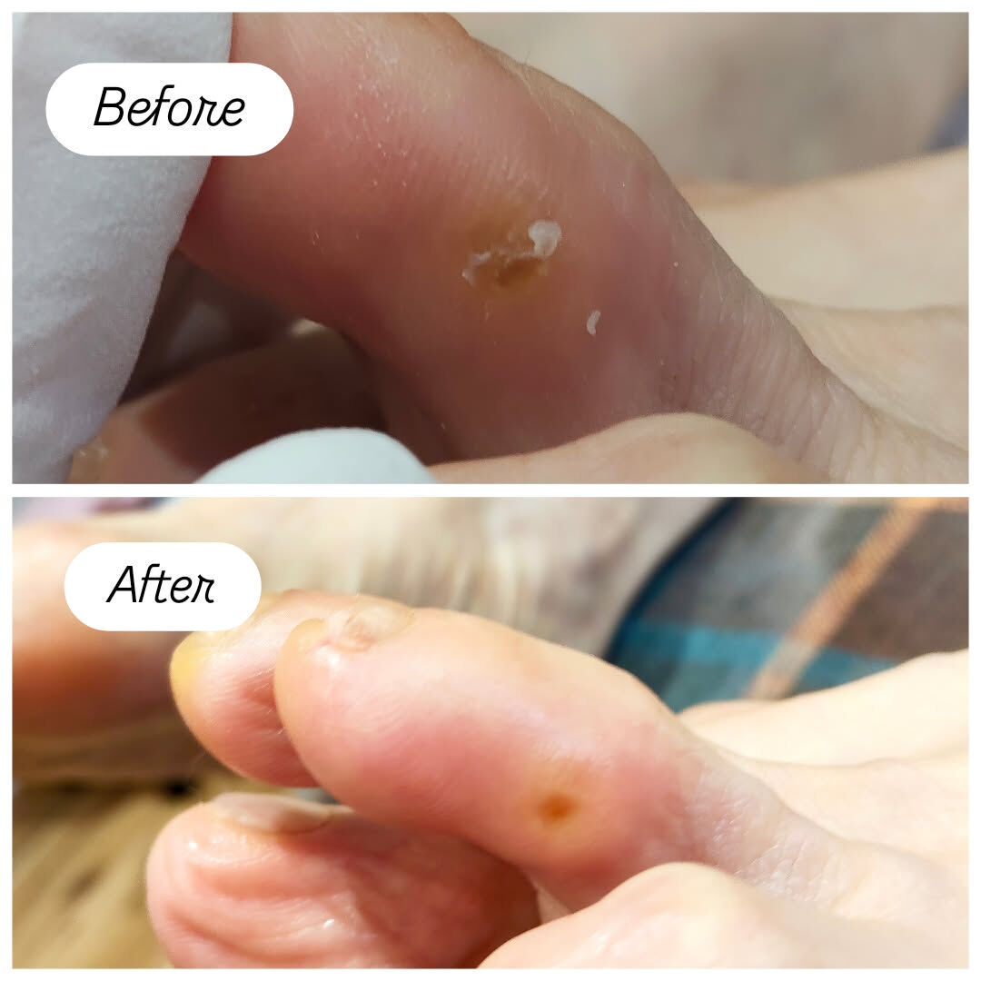 魚の目ケア👣✨