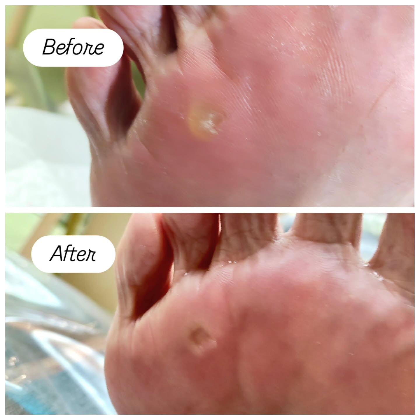 魚の目ケア👣✨