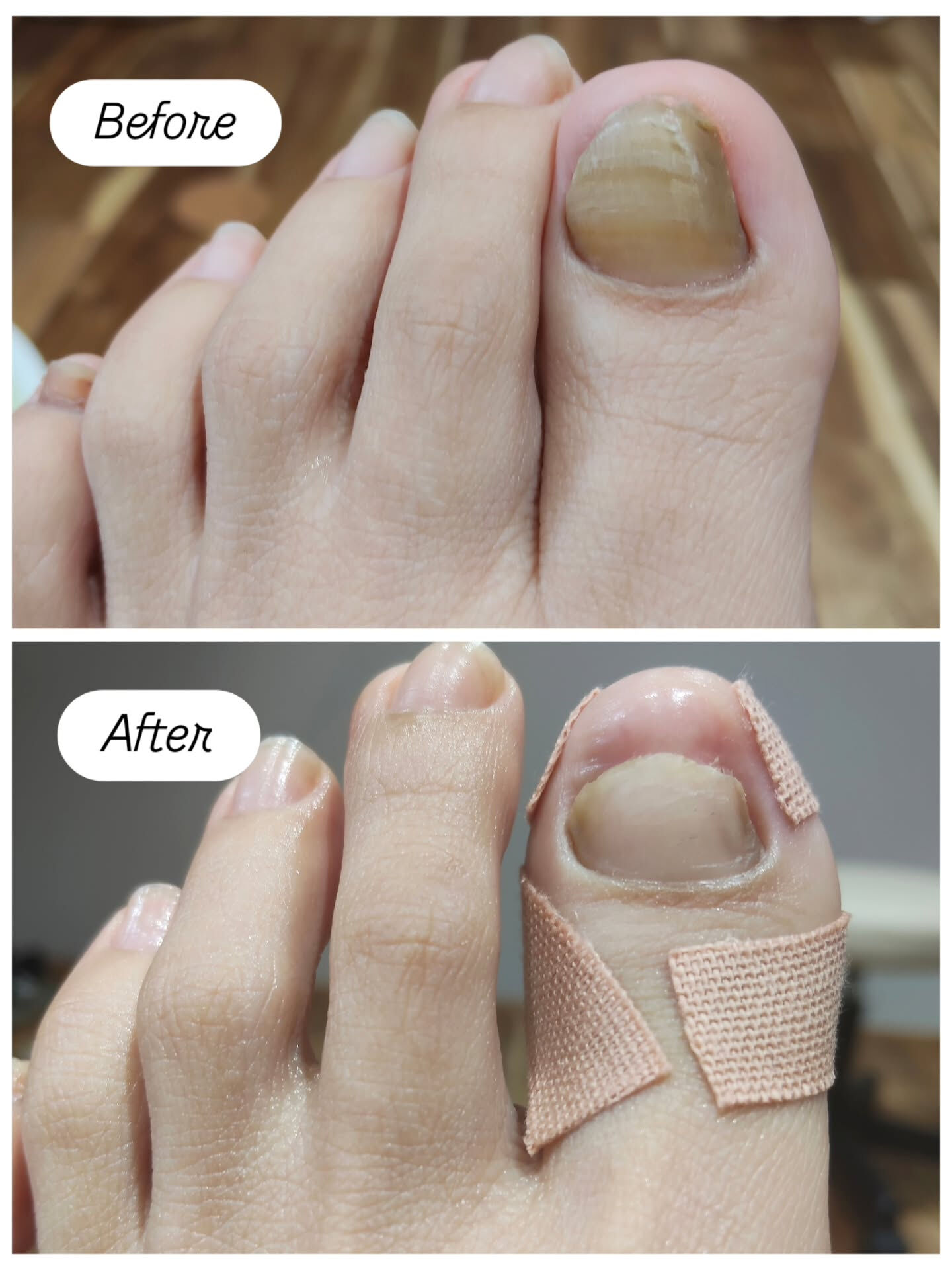 肥厚爪ケア👣✨