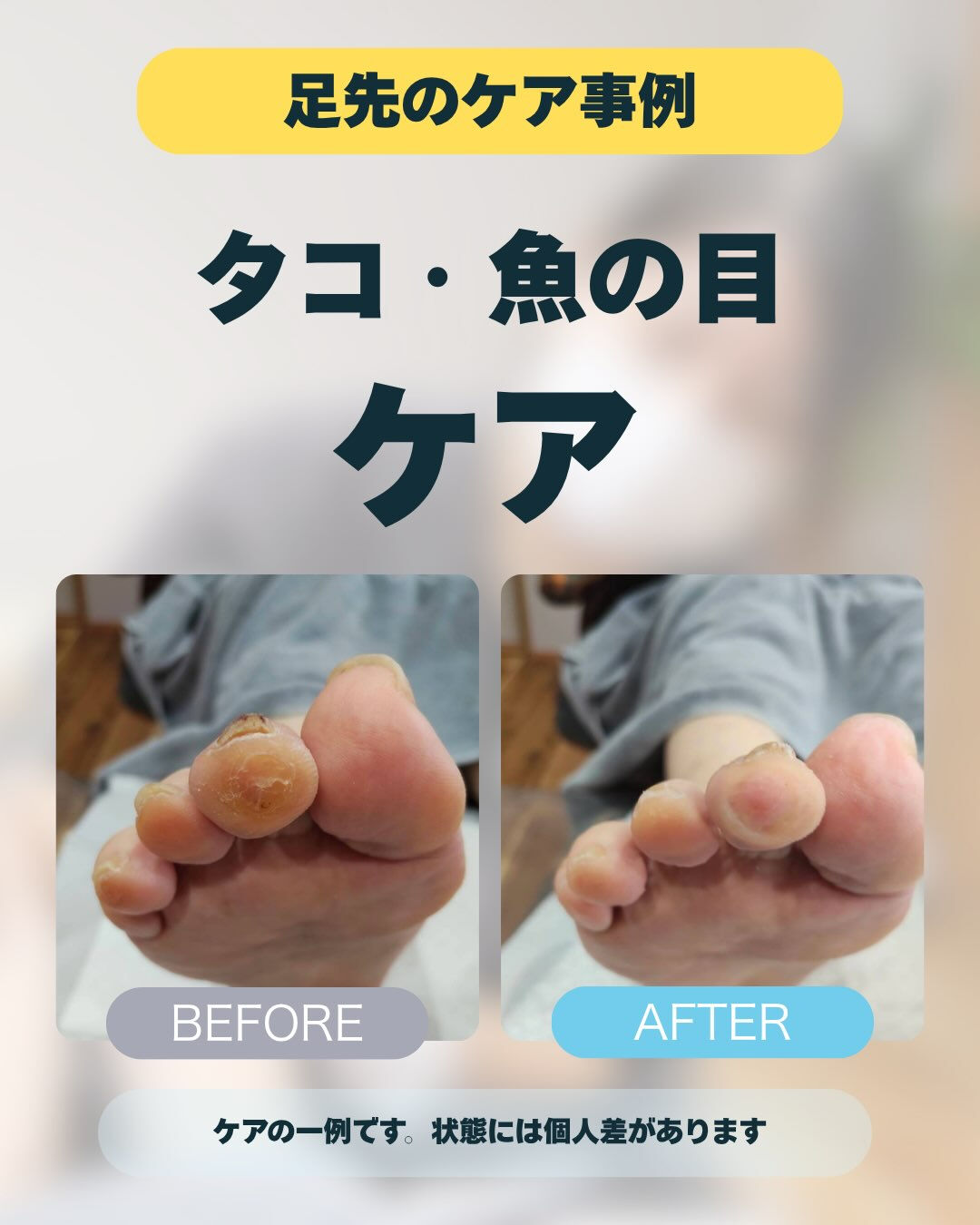 【足先のタコ・魚の目、気になっていませんか？🦶】